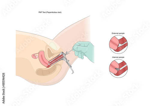 pap test (Papanikolau test), a medical examination of cervix to prevent cancer
