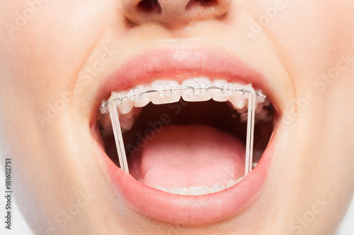Woman mouth with orthodontic elastics on braces