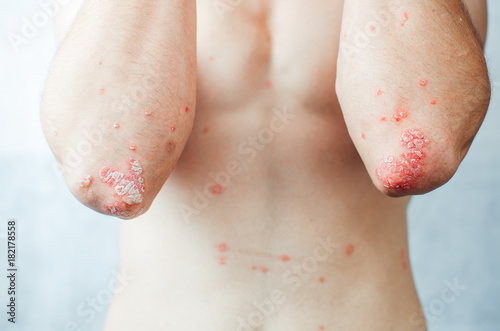 on the Elbows Psoriasis