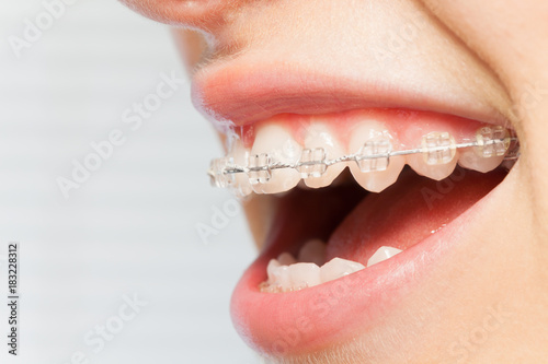 Orthodontics correction of jaws with clear bracket