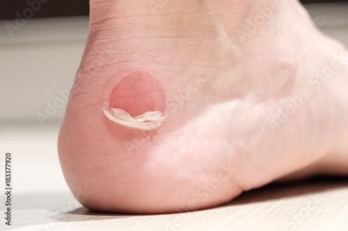 Big bloody callus on man's heel