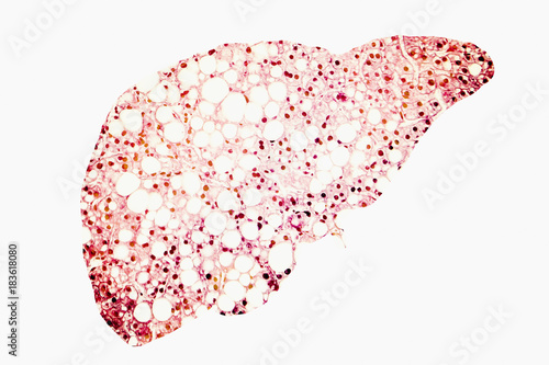 Fatty liver conceptual image, 3D illustration showing fatty liver silhouette made from micrograph of liver steatosis