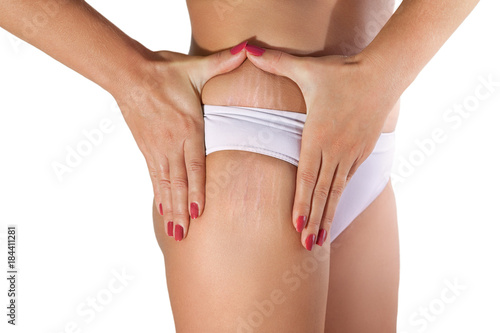 Woman examining her stretch marks