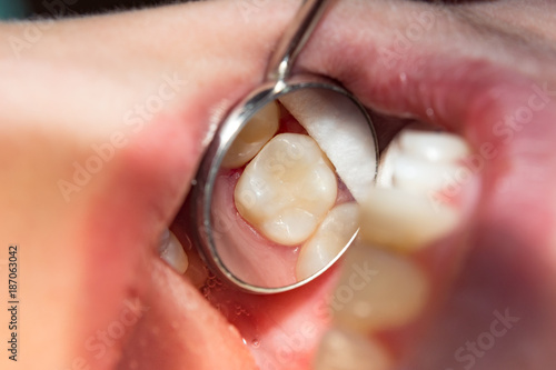 two chewing side teeth of the upper jaw after treatment of caries. Restoration of the chewing surface with a photopolymer filling material using the Rubber Dam system