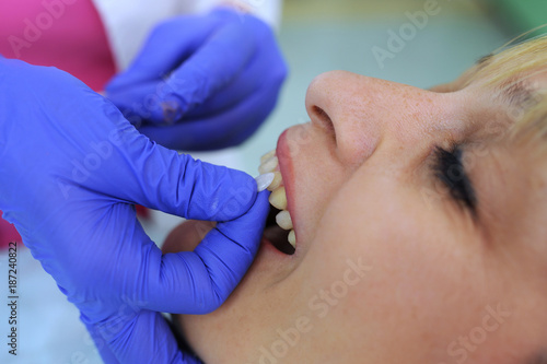 Dentist puts dental veneers patient and correction of teeth