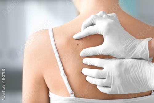 Dermatologist examining birthmark of patient, closeup. Cancer concept