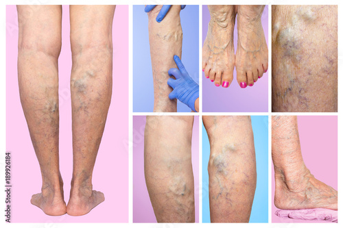 Lower limb vascular examination because suspect of venous insufficiency.