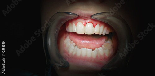 Mouth with bleeding gums on a dark background.