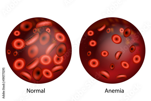 Iron deficiency anemia.The difference of Anemia amount of red blood cell and normal. 