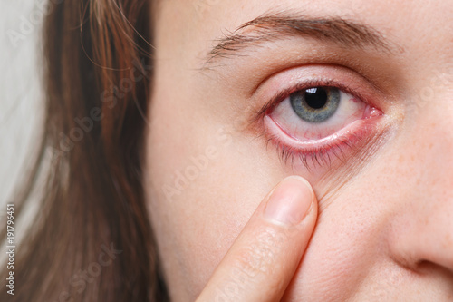 Medicine, health care and eyesight concept. Unrecognizable female shows her inflated red eye with blood capillary, has conjuctivitis. Woman with injured eye