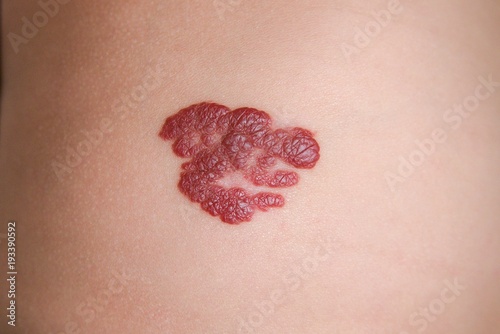 Infantile Hemangioma red birthmark (also called strawberry mark) on the baby's belly. Infantile Hemangiomas (IHs) are the most common tumors of childhood.