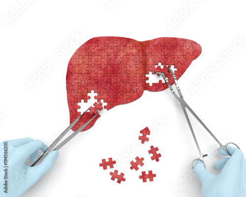 Liver operation puzzle concept: hands of surgeon with surgical instruments (tools) performs liver surgery as a result of hepatic disorder (cirrhosis, hepatic cancer, hepatitis)