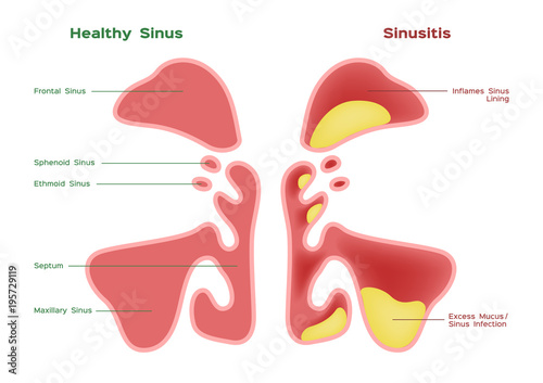 nasal sinus. Healthy and inflammation sinus vector