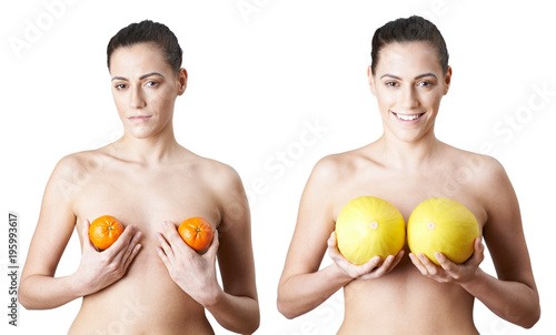 Woman Holding Satsumas And Melons To Illustrate Breast Enlargement Surgery