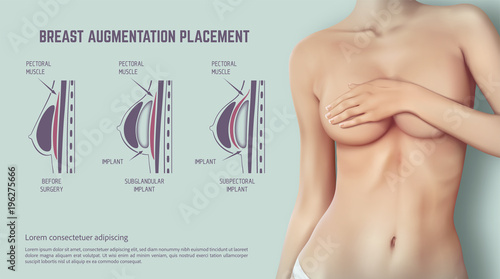Diagram about method of insertion for breast implant. Plastic surgery of breast implants illustration.