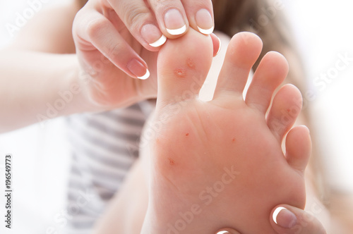 female foot with problem areas on the skin,