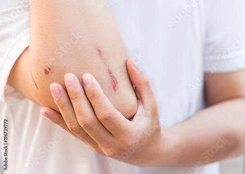 Man show lesion or wound on his arm after accident