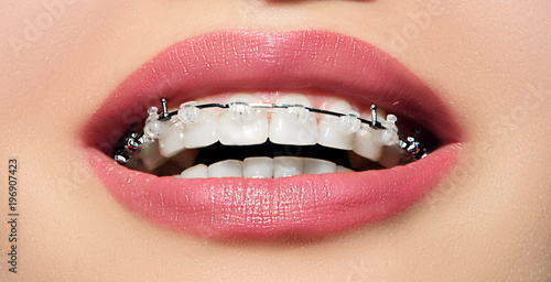 Closeup female smile with ceramic braces teeth. Orthodontic treatment. Open mouth with clear brackets.