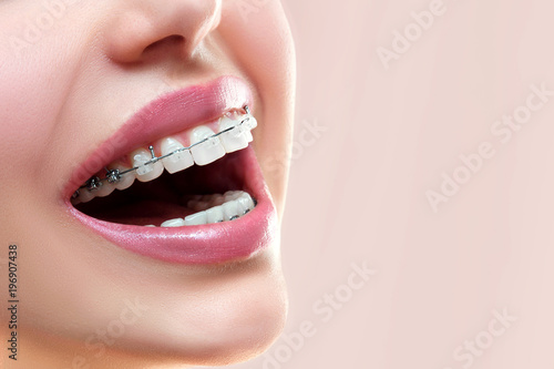 Zamknij piękne usta ceramicznymi i metalowymi szelkami na pięknych zębach. Szeroki uśmiech dzięki uchwytom samoligaturującym. Leczenie ortodontyczne. Kobieta uśmiecha się pokazując aparat ortodontyczny ..