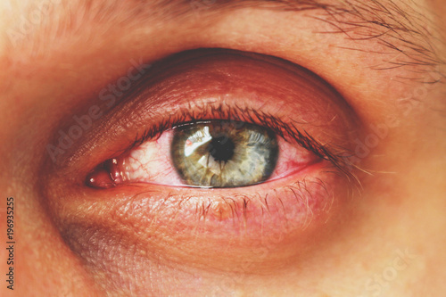 red eye of a patient with human conjunctivitis, retro toned