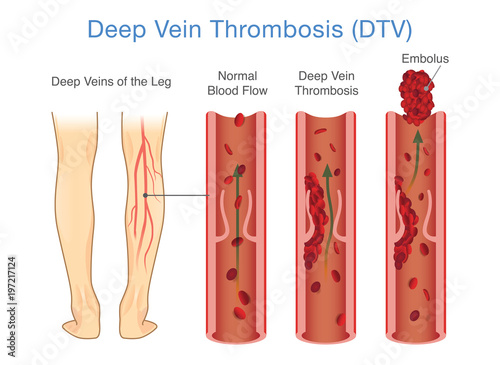 Medical Diagram of Deep Vein Thrombosis at leg area. Illustration about abnormally of blood floow.