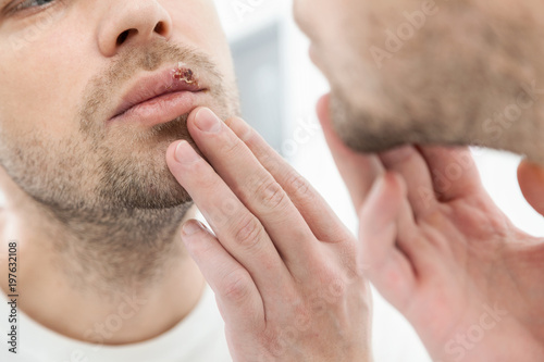 Young man suffering from herpes on his mouth