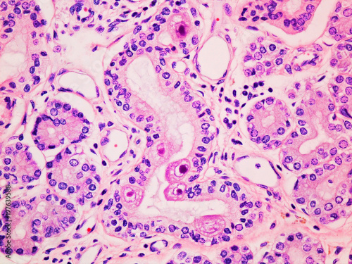 Cytomegalovirus CMV infection in the salivary gland viewed at 400x magnification with haemotoxylin and eosin staining