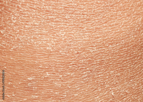  texture of the epidermis of human skin with flakes and cracked particles closeup