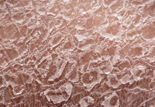 unhealthy human skin epidermis texture with flaking and cracked particles close-up