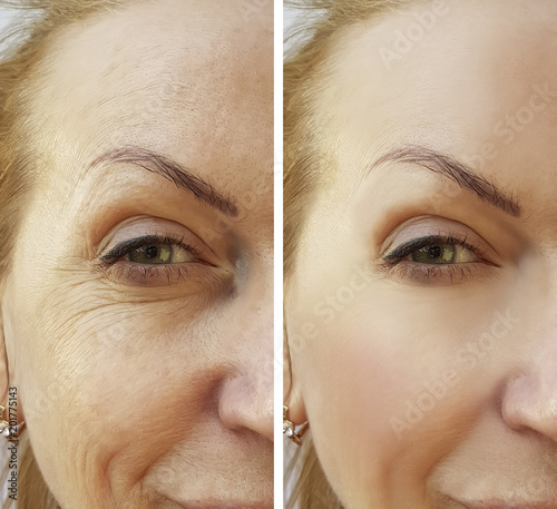 woman face wrinkles before and after procedures