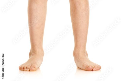 Closeup of naked little boy with valgus deformity of legs