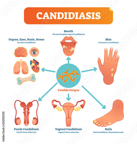 Candidiasis medical vector illustration diagram poster with all types of candida fungus on various human body parts and organs.