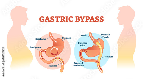 Gastric bypass medical surgery procedure vector illustration with esophagus, stomach, duodenum and jejunum flow.