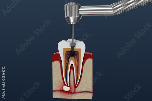 Root canal treatment process. 3D illustration