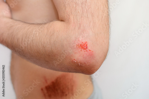 close-up bleeding wound or bruised hand on the elbow of a man on a white isolated background