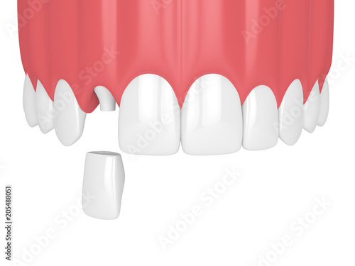 3d render of upper jaw with teeth and dental lateral incisor crown