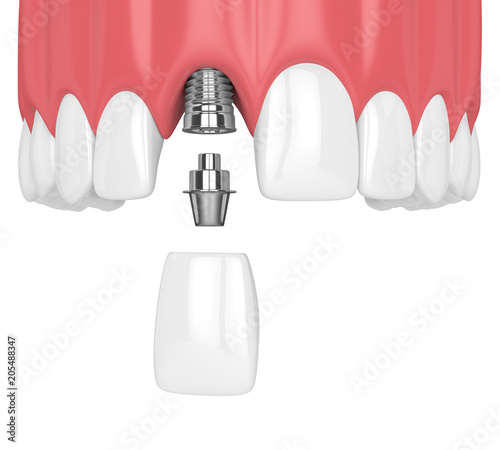 3d render of upper jaw with teeth and dental incisor implant