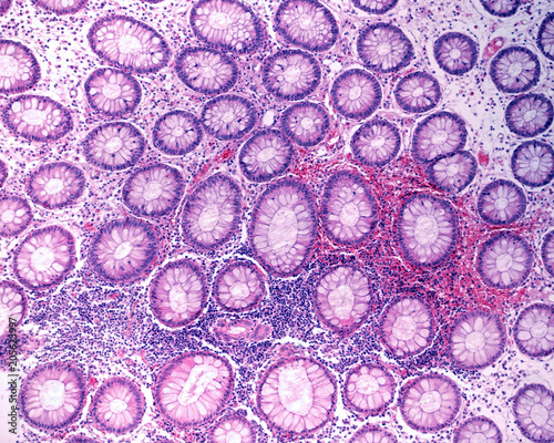 Colon. Chronic inflammation