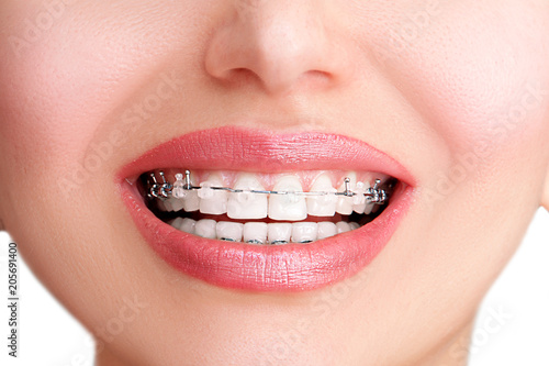 Closeup Ceramic and Metal Braces on Teeth. Beautiful Female Smile with clear Braces. Orthodontic Treatment.