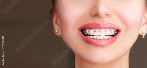 Braces on Teeth. Beautiful Female Smile with Self-ligating Braces. Orthodontic Treatment.