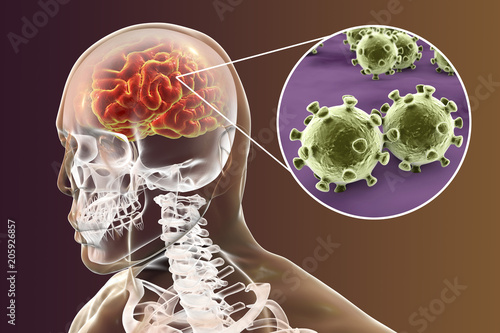 Viral meningitis and encephalitis, medical concept, 3D illustration showing brain infection and close-up view of viruses in the brain