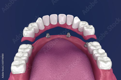 Overdenture to be seated on 4 implants - ball attachments. 3D illustration