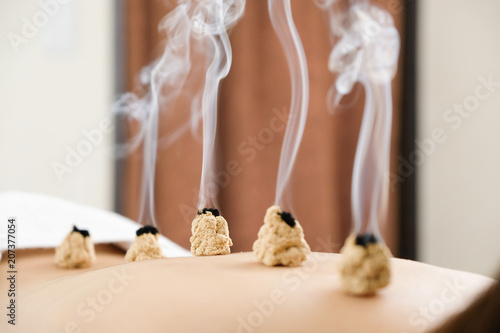 明るい鍼灸院で女性の背中に置かれた煙が出ているお灸