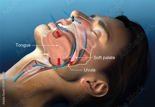 Snoring, medical illustration with caption
