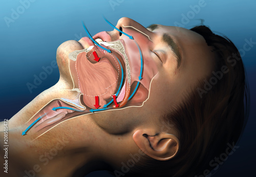 Snoring, medical illustration