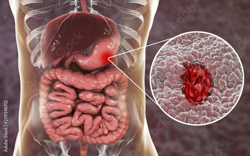 Gastric ulcer. Mucosa of stomach with ulcer and anatomy of human digestive system. 3D illustration