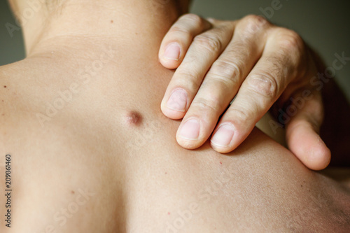 Fibroma on the male back, details, close-up