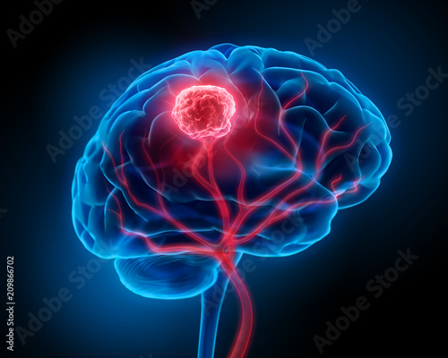 Hirntumor isoliert