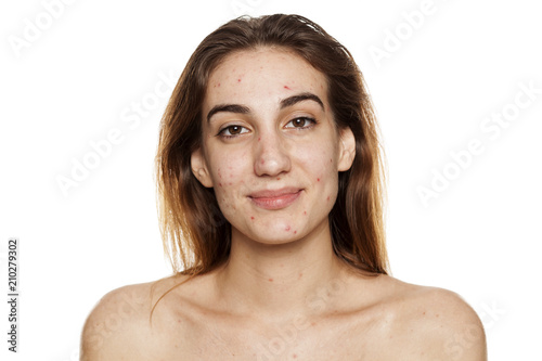 young smiling woman with problematic skin and without makeup poses on a white background