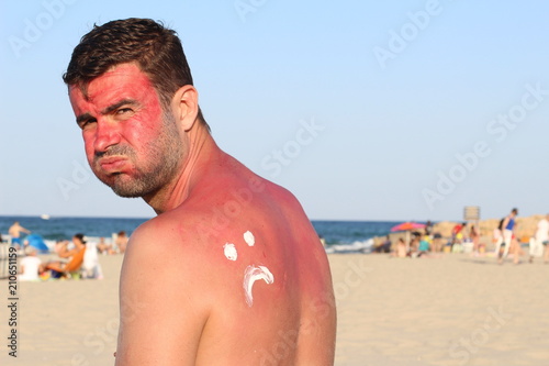 Man getting sunburned at the beach